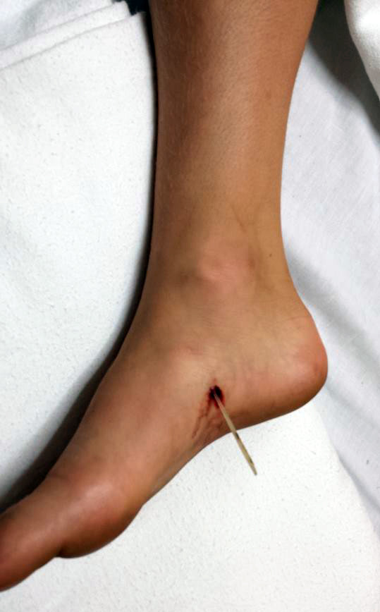stingrays injury