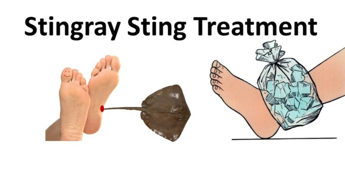 Stingray Sting Treatment