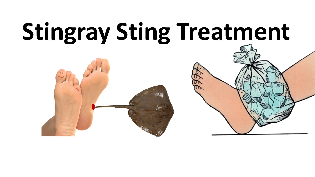 Stingray Sting Treatment