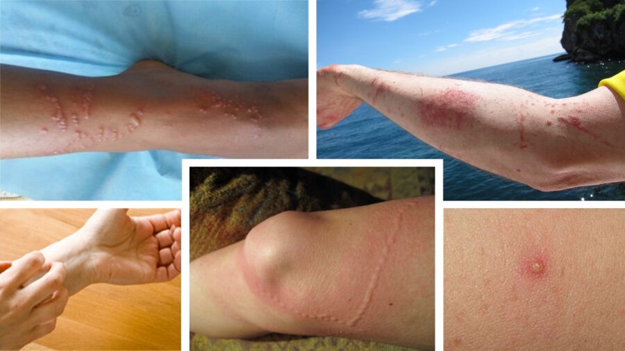 (Why Is My Jellyfish Sting Itching A Week Later)