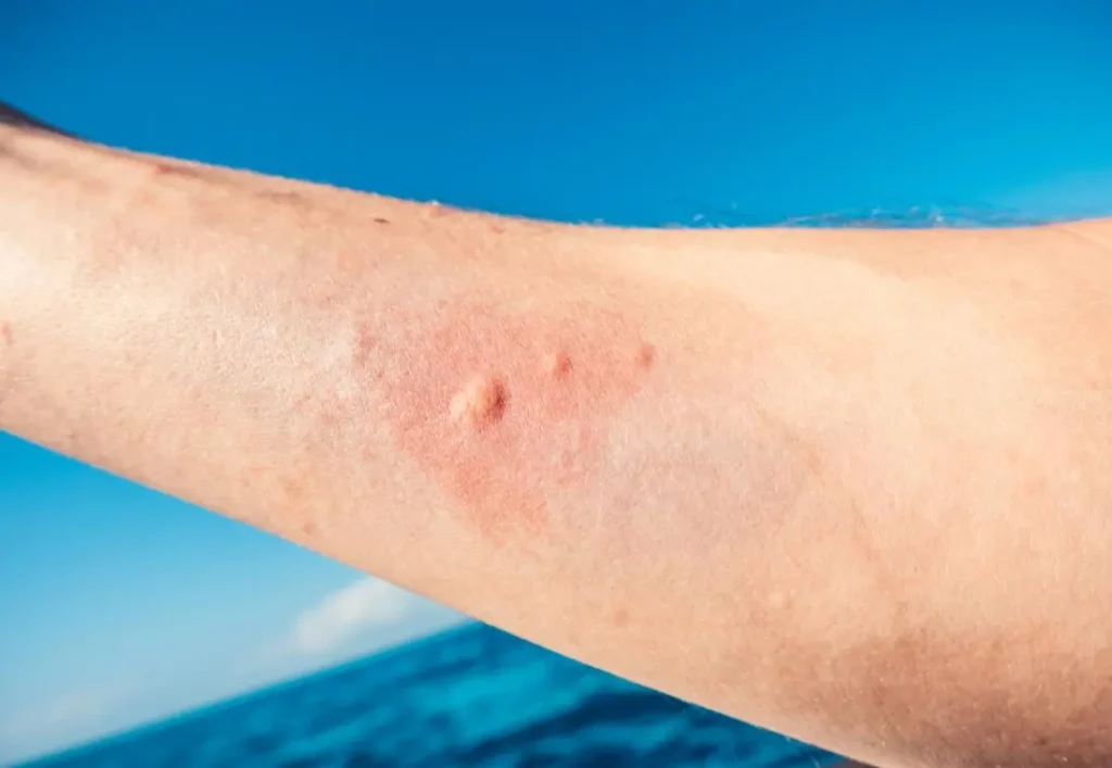 Why Is My Jellyfish Sting Itching A Week Later