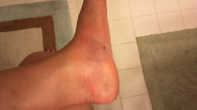 Stingray Sting Long-Term Effects
