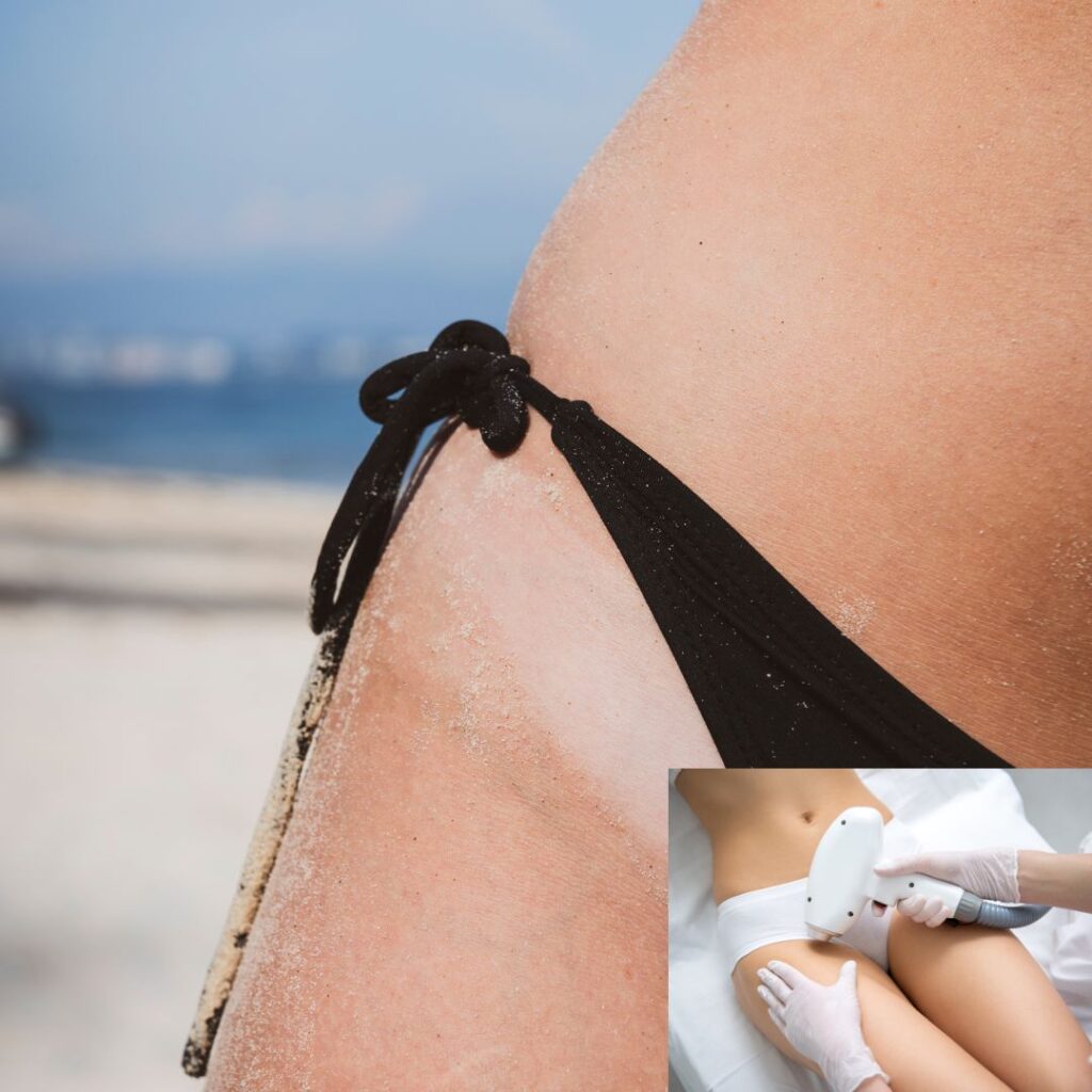 Exfoliation to Prevent Bikini Line Dark Spots